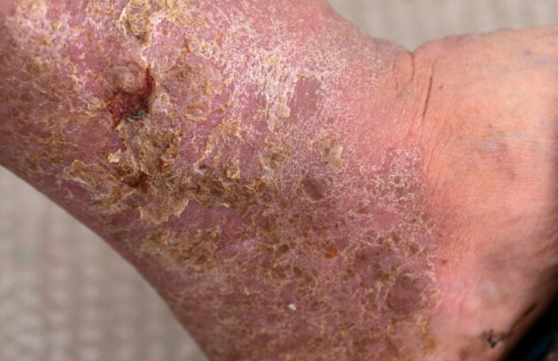 What Are Chronic Wounds and How Are They Treated?